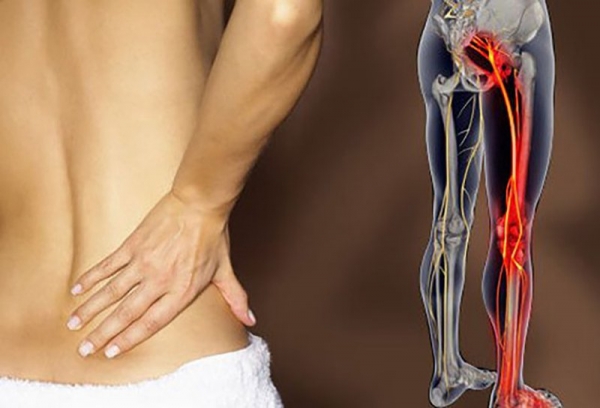 Triệu chứng đau thần kinh tọa và những điều ít người biết