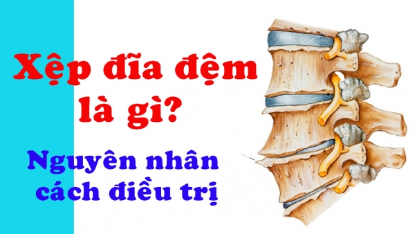 Xệp đĩa đệm là gì? Nguyên nhân và cách điều trị?