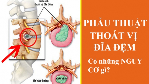 Phẫu thuật THOÁT VỊ ĐĨA ĐỆM có những NGUY CƠ gì?
