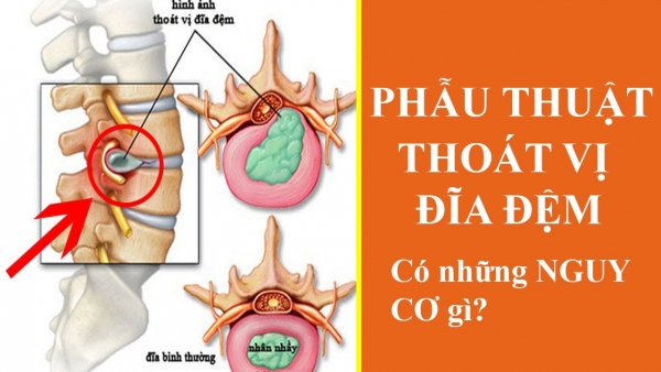 Phẫu thuật THOÁT VỊ ĐĨA ĐỆM có những NGUY CƠ gì?