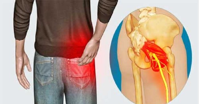 Đau dây thần kinh tọa