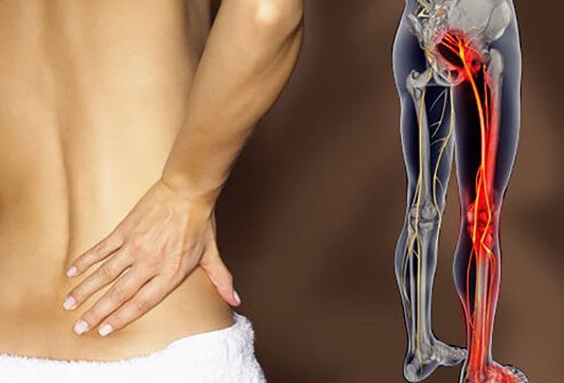 Triệu chứng đau thần kinh tọa và những điều ít người biết