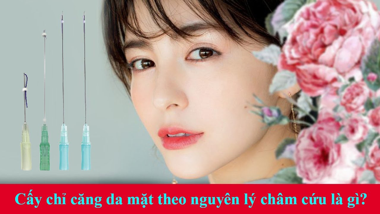 Cấy chỉ căng da mặt theo nguyên lý châm cứu là gì? Ưu nhược điểm?