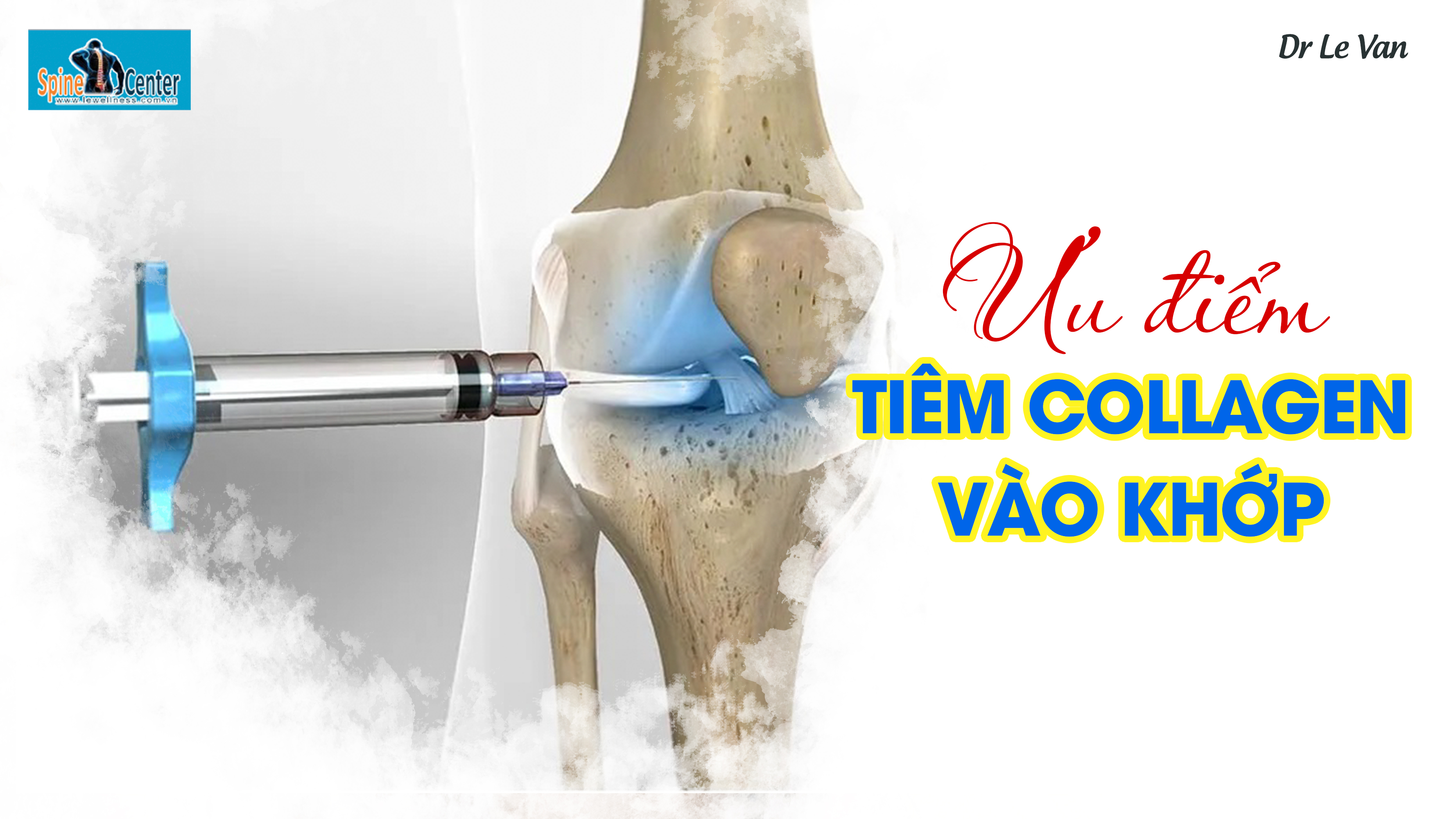 Ưu điểm của phương pháp tiêm collagen vào khớp