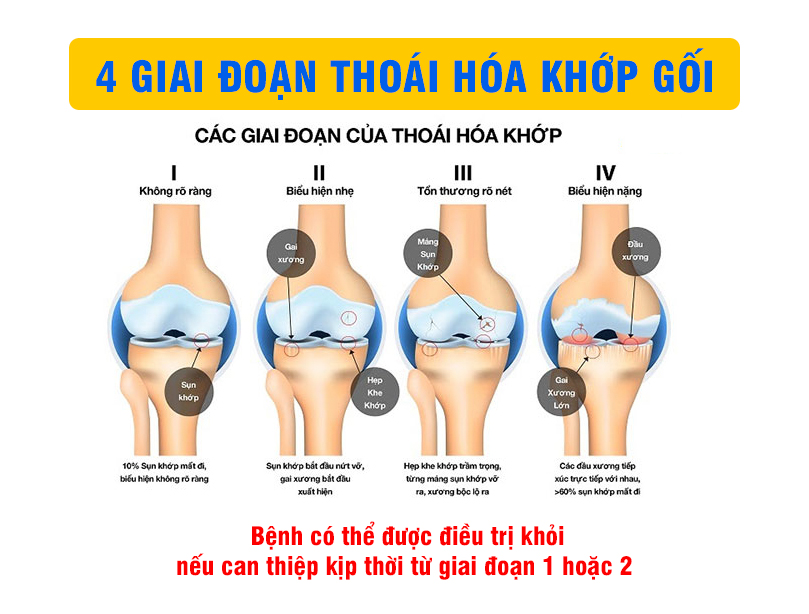 KHÔ KHỚP GỐI và CÁC BIẾN CHỨNG NGUY HIỄM